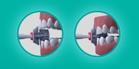 Balene es el primer cepillo del mundo que limpia la cara interna, externa y superficie de masticado de los dientes a la vez. Su tecnología sónica traslada un movimiento vertical de alta frecuencia a los filamentos, asegurando una limpieza profunda en toda la dentadura. ¿Qué incluye el Starter Kit? Base del cepillo, 1 cabezal de dureza media y un cargador.